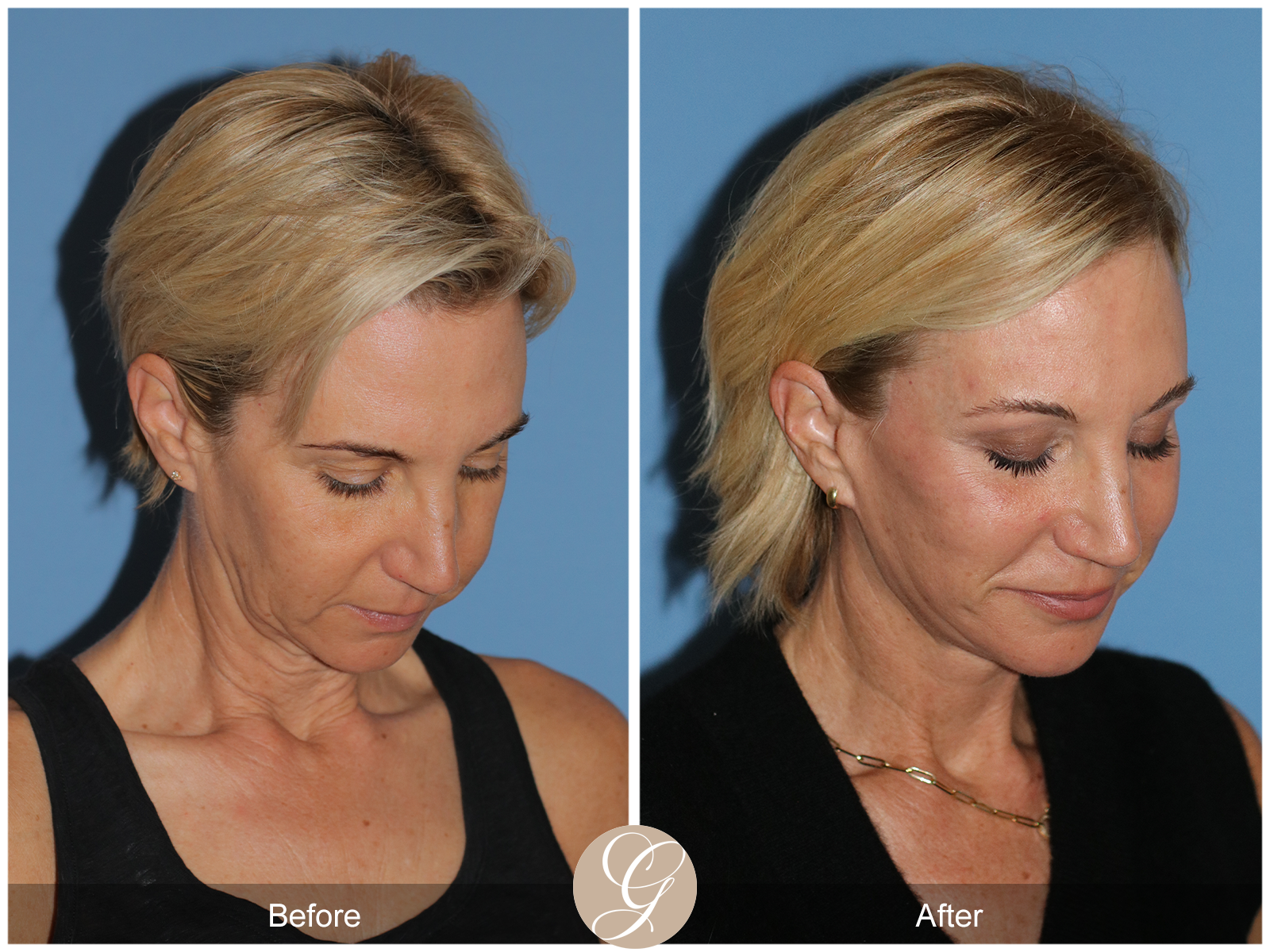 Deep Plane Facelift Case 31 Image