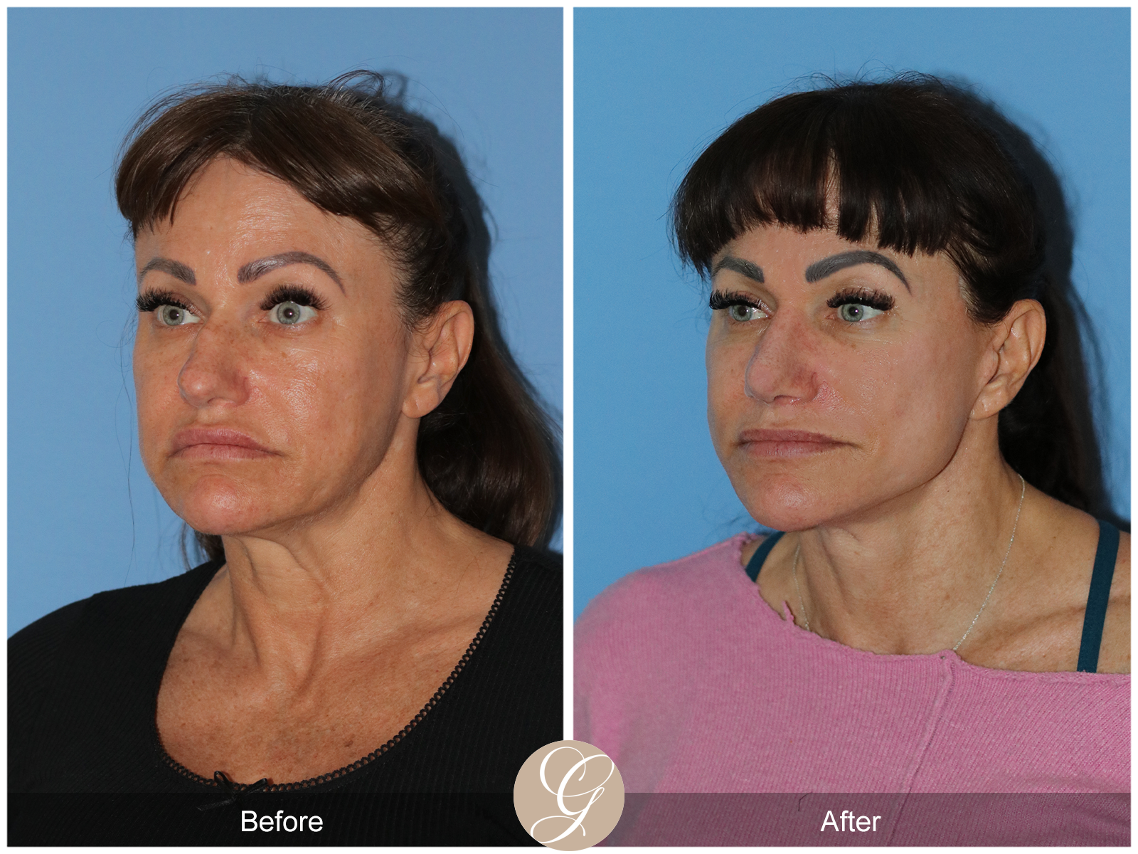 Preservation Deep Plane Facelift Case 47 Image