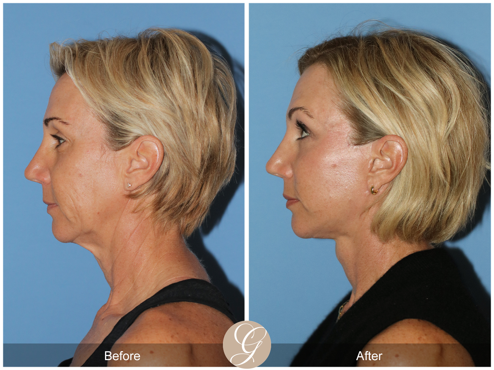 Deep Plane Facelift Case 31 Image