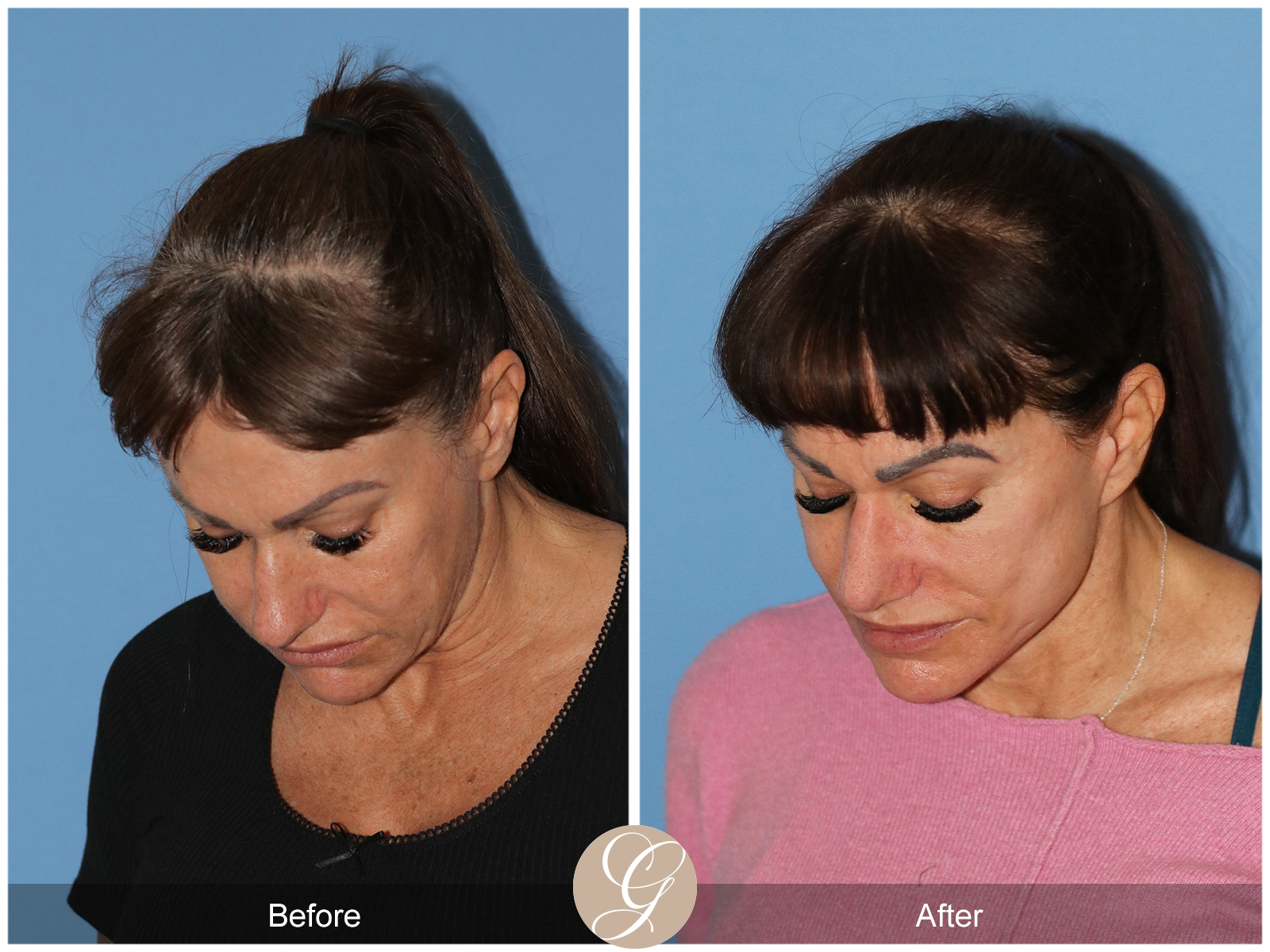 Preservation Deep Plane Facelift Case 47 Image