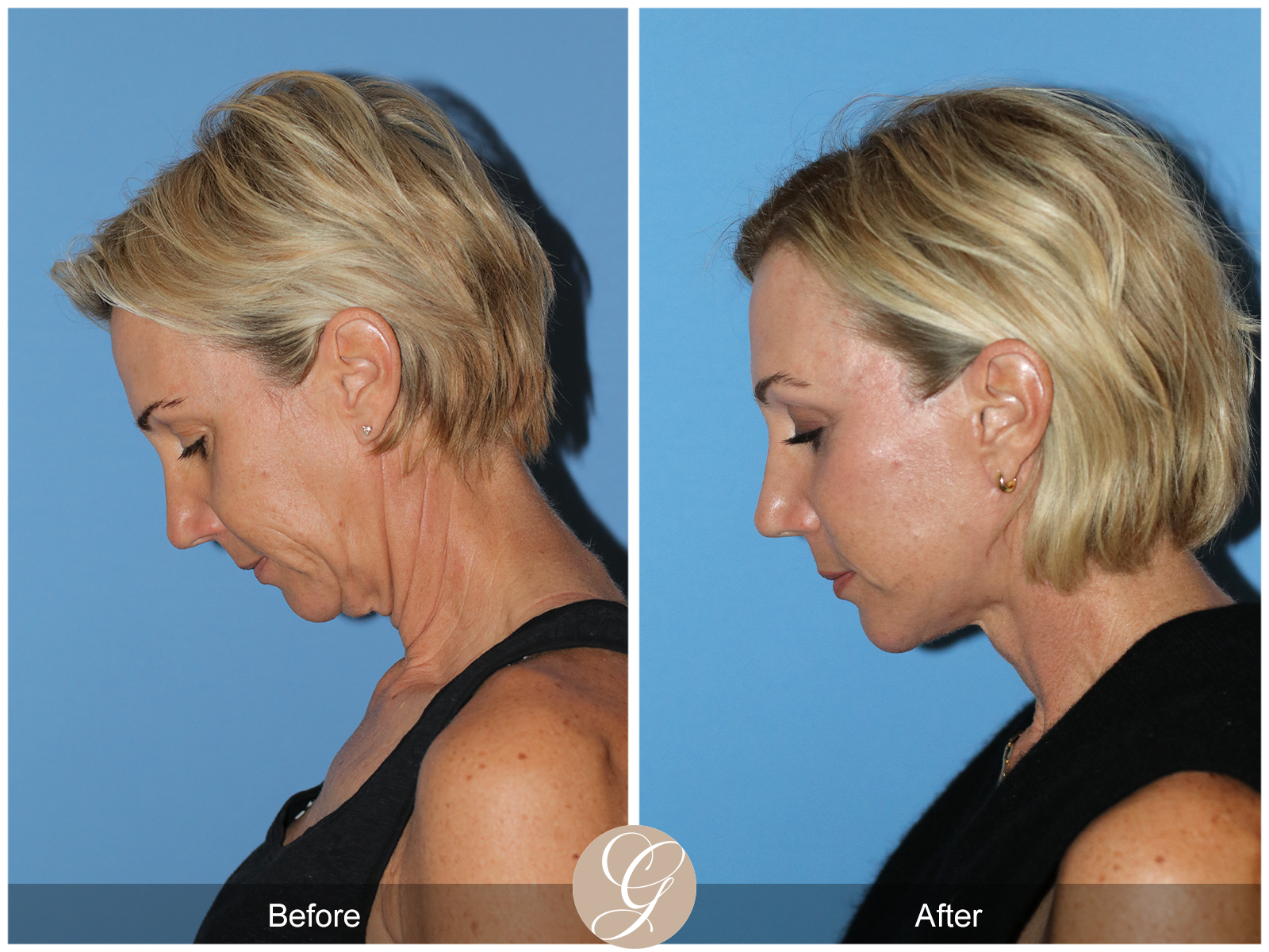 Deep Plane Facelift Case 31 Image