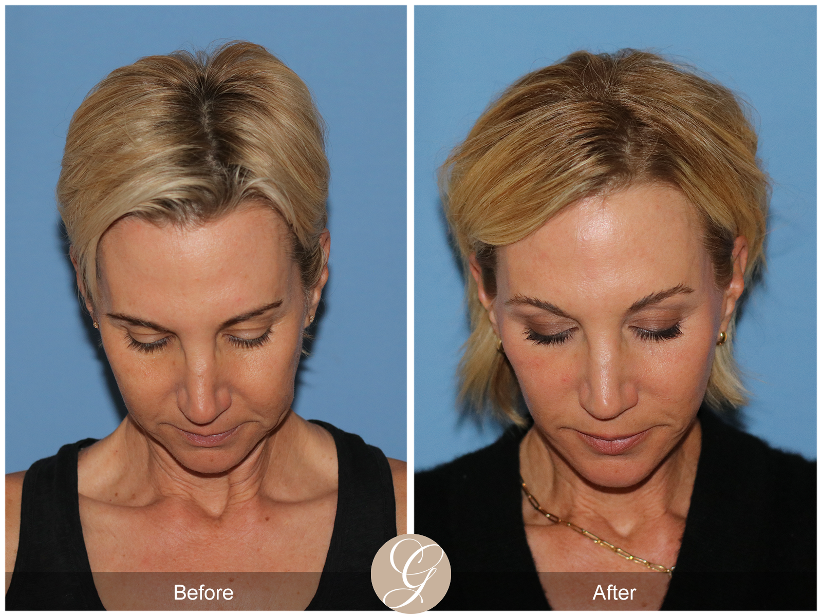 Deep Plane Facelift Case 31 Image