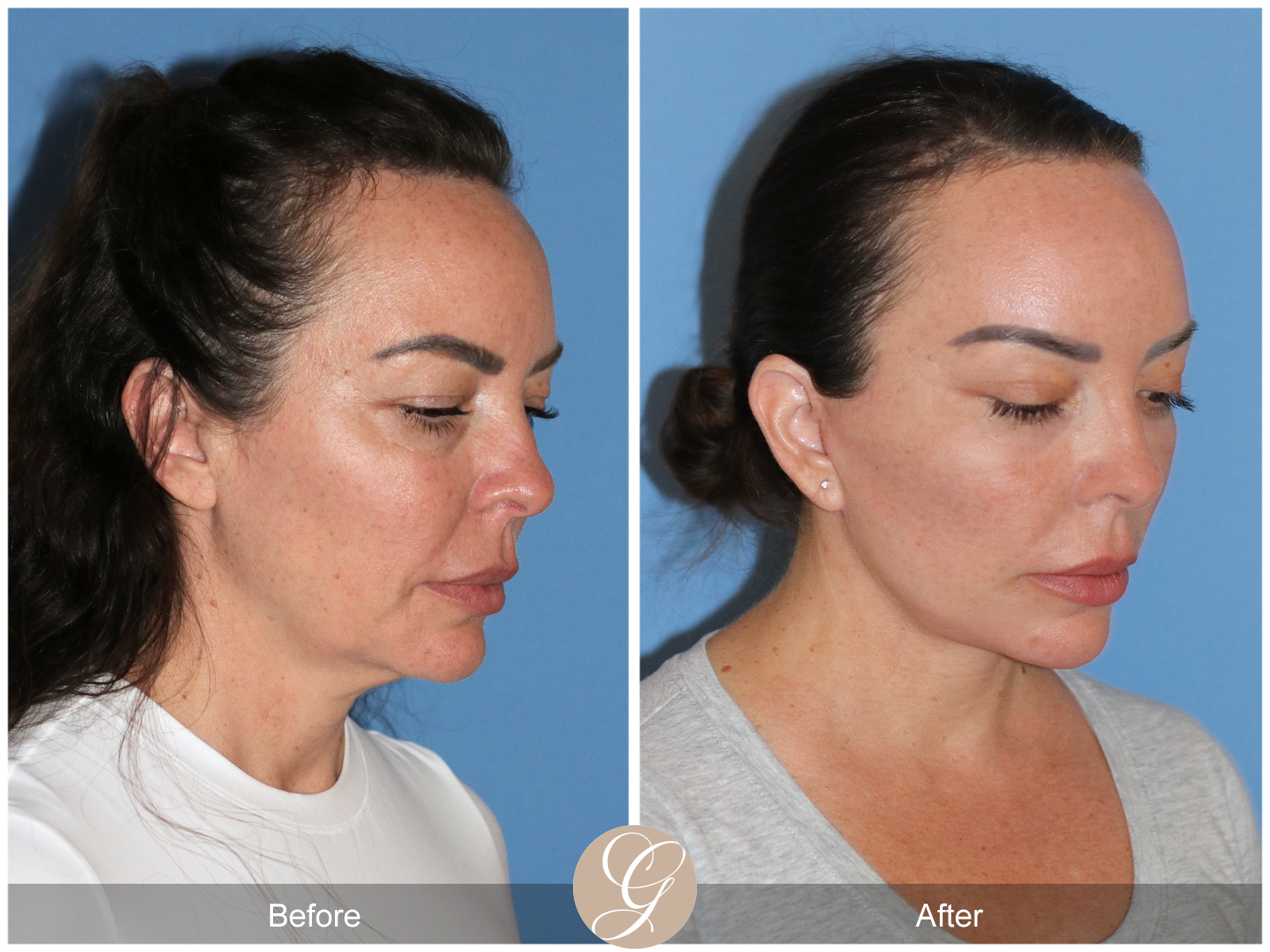 Preservation Deep Plane Facelift Case 46 Image