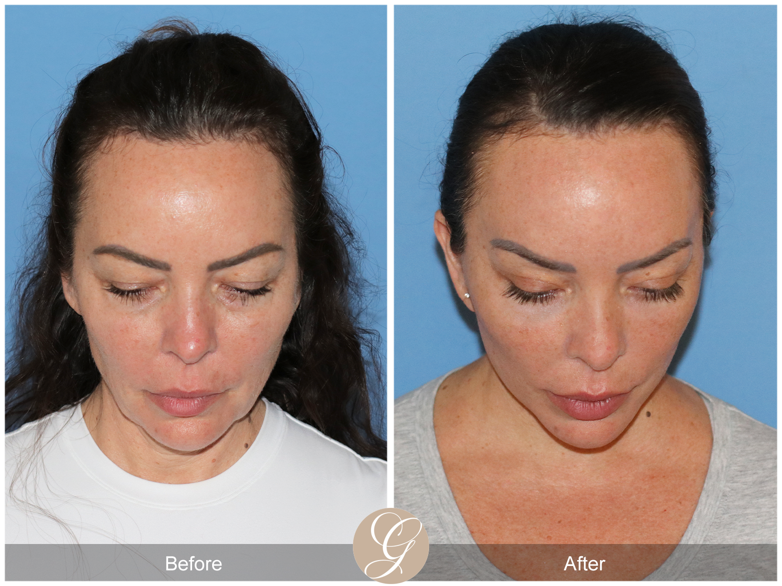 Preservation Deep Plane Facelift Case 46 Image