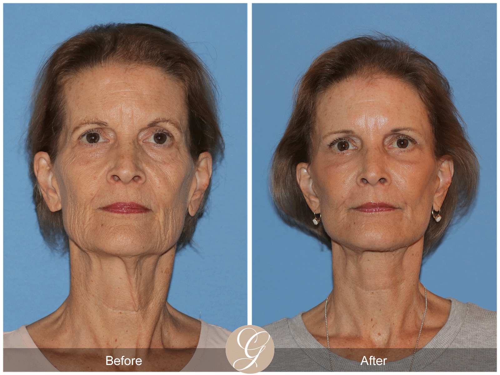 Deep Plane Facelift Case 36 Image