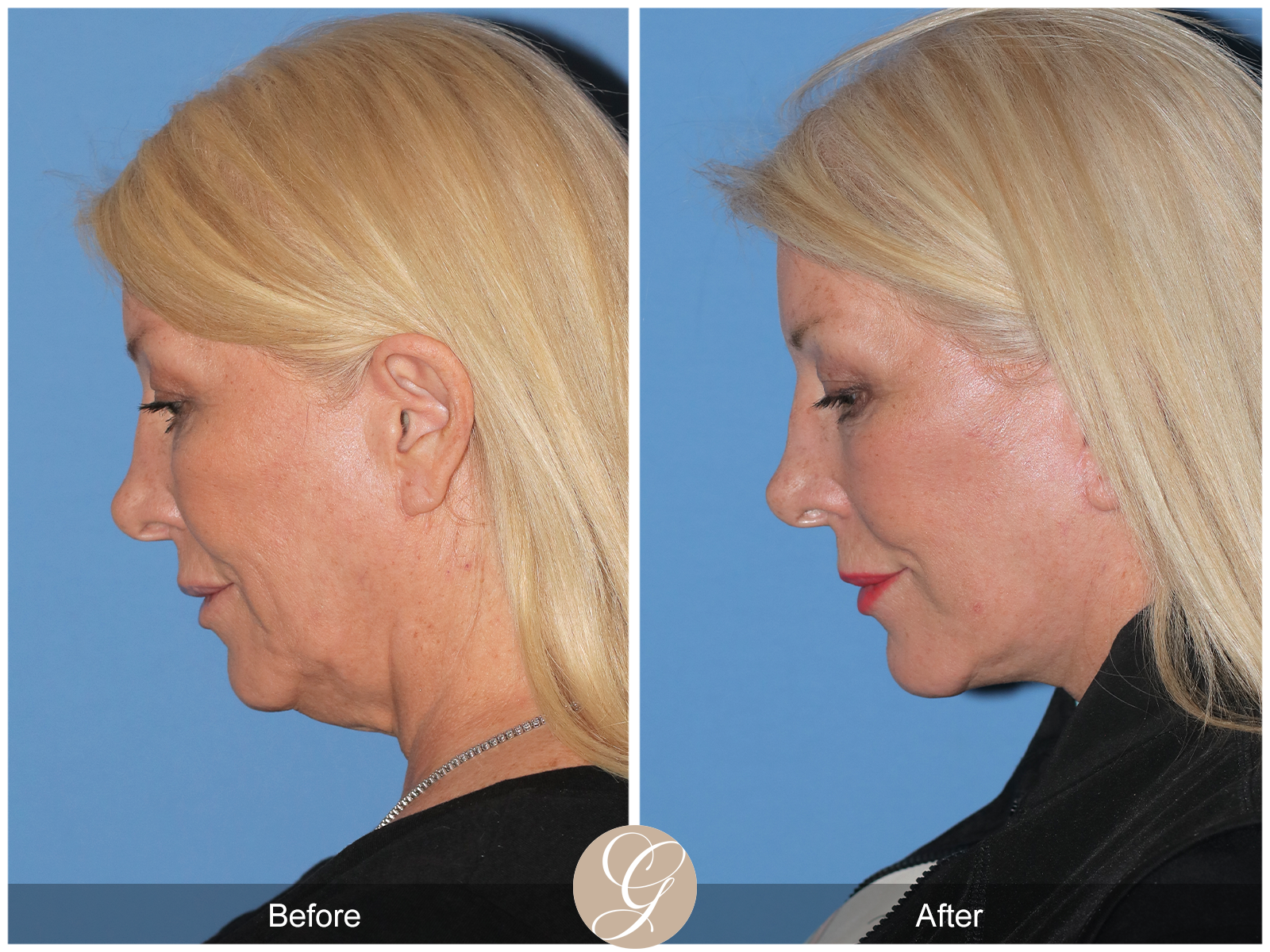 Deep Plane Facelift Case 35 Image
