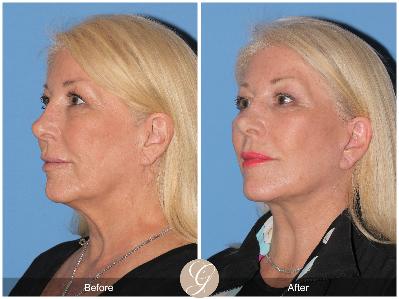 Deep Plane Facelift Case 35 Image