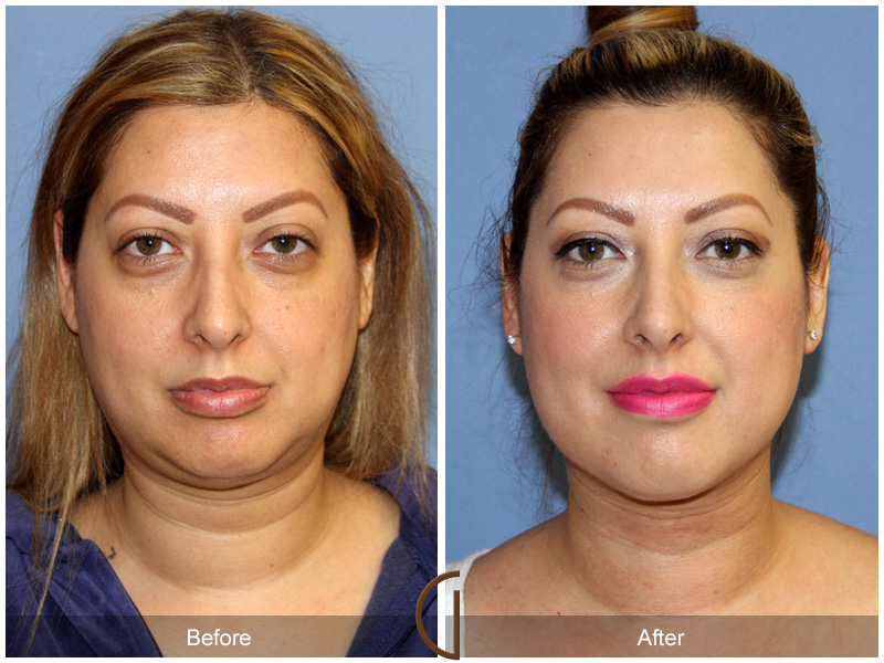 Facial Contouring Case 9 Image
