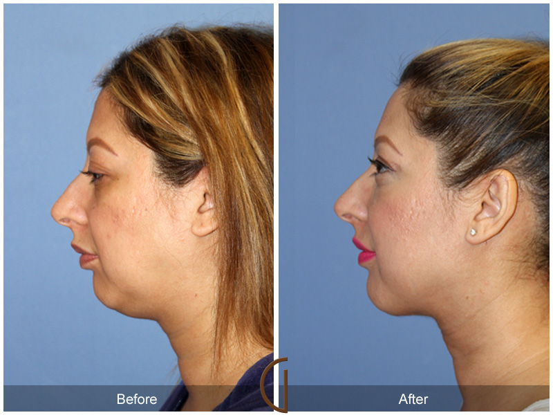 Facial Contouring Case 9 Image