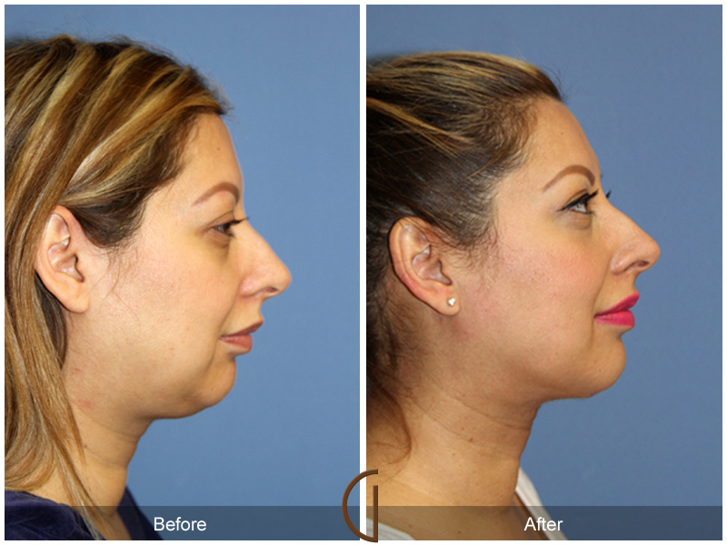 Facial Contouring Case 9 Image