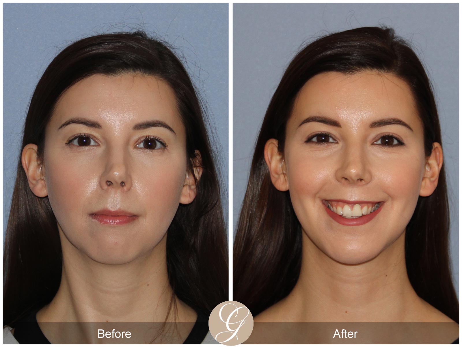 Facial Contouring Case 7 Image