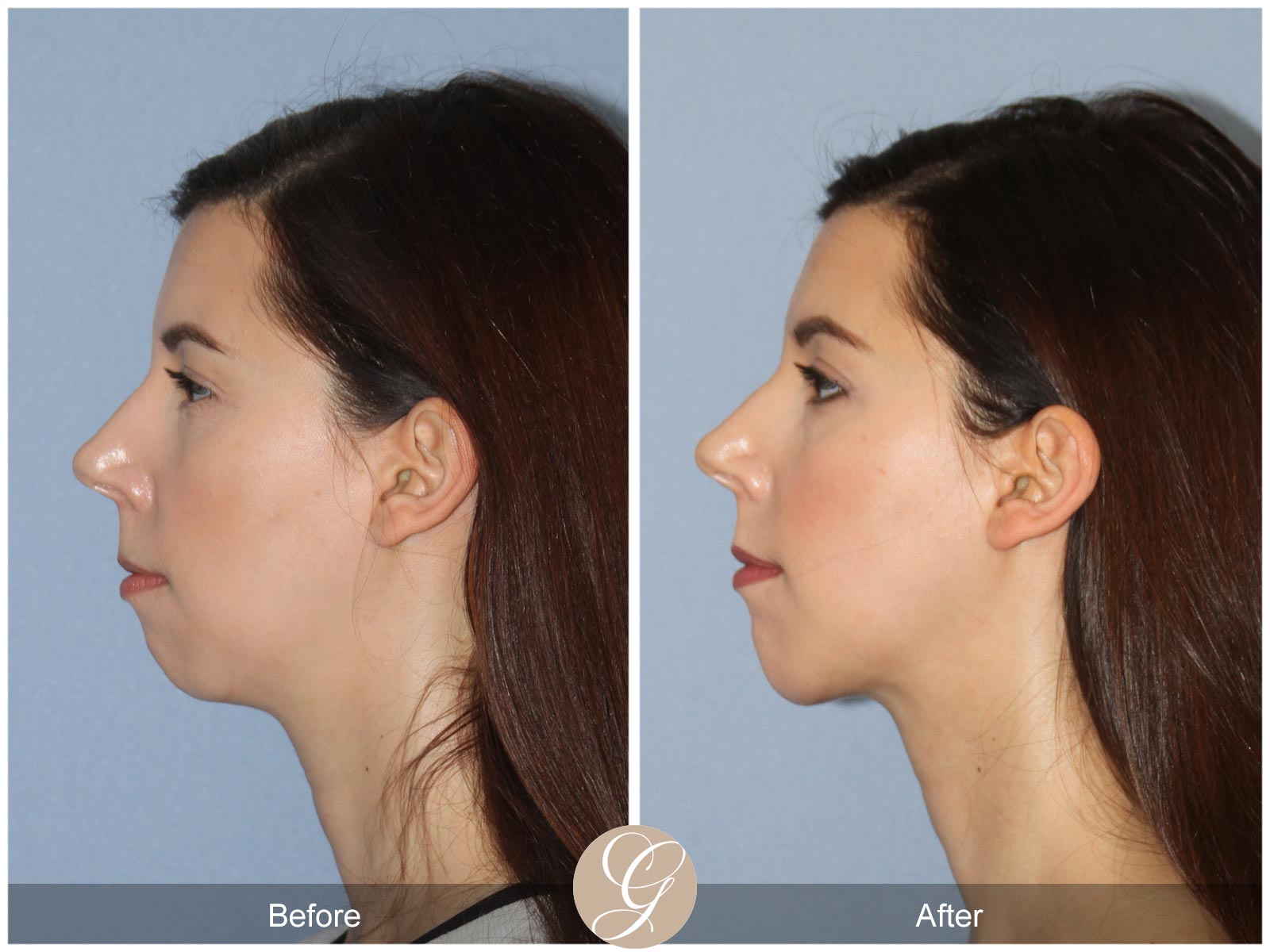 Facial Contouring Case 7 Image