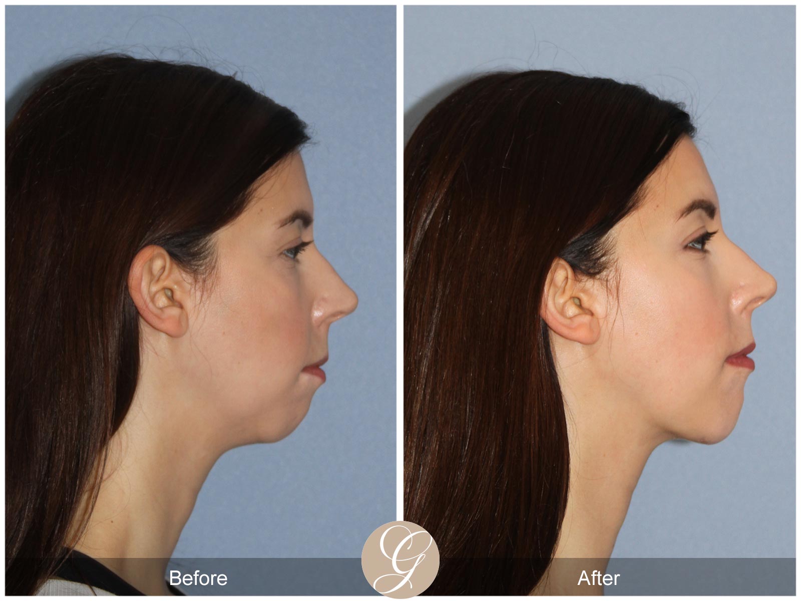 Facial Contouring Case 7 Image