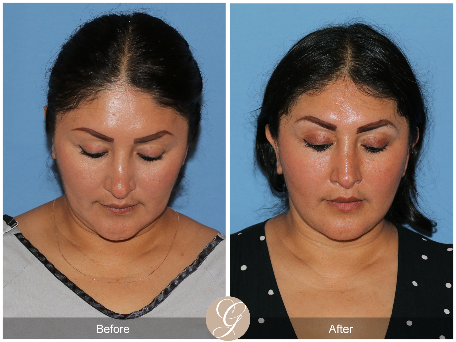 Deep Plane Facelift Case 42 Image