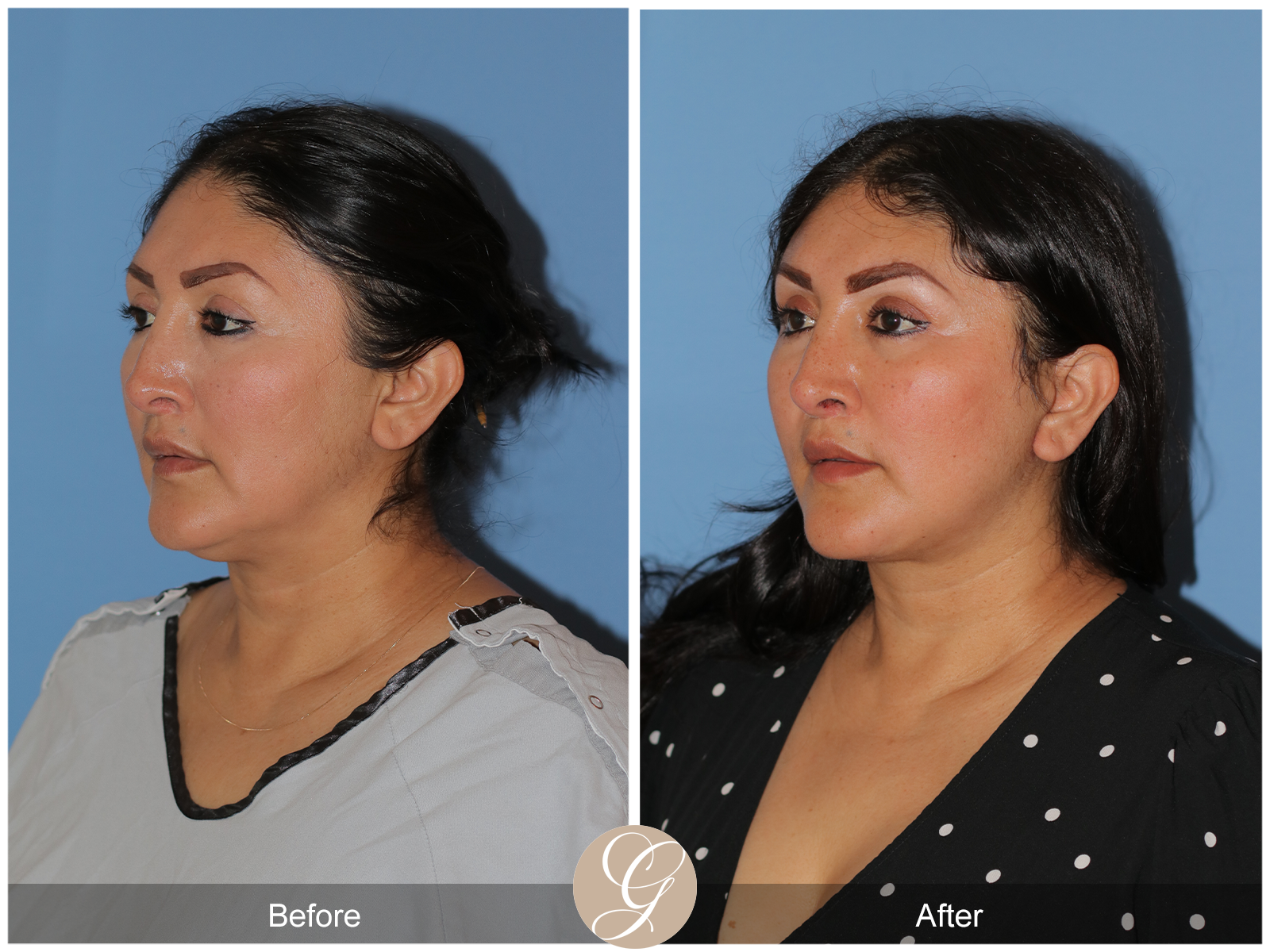 Deep Plane Facelift Case 42 Image