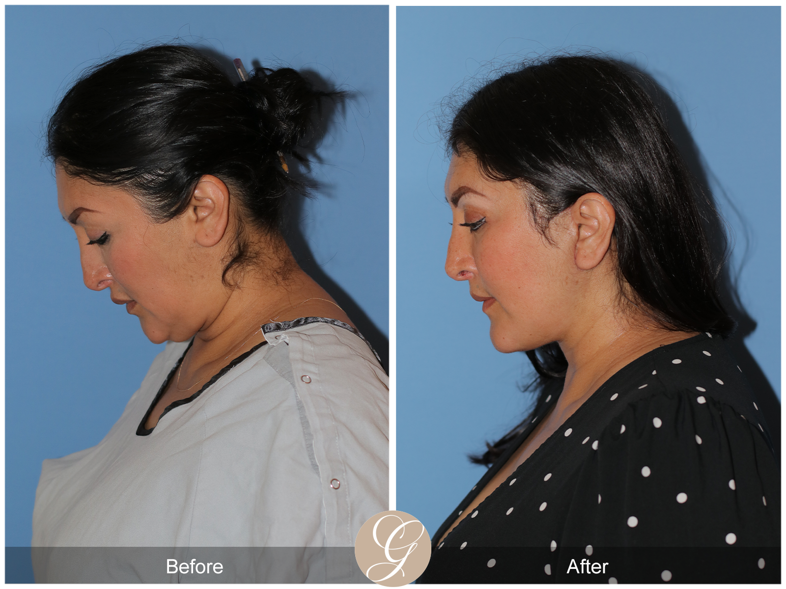 Deep Plane Facelift Case 42 Image