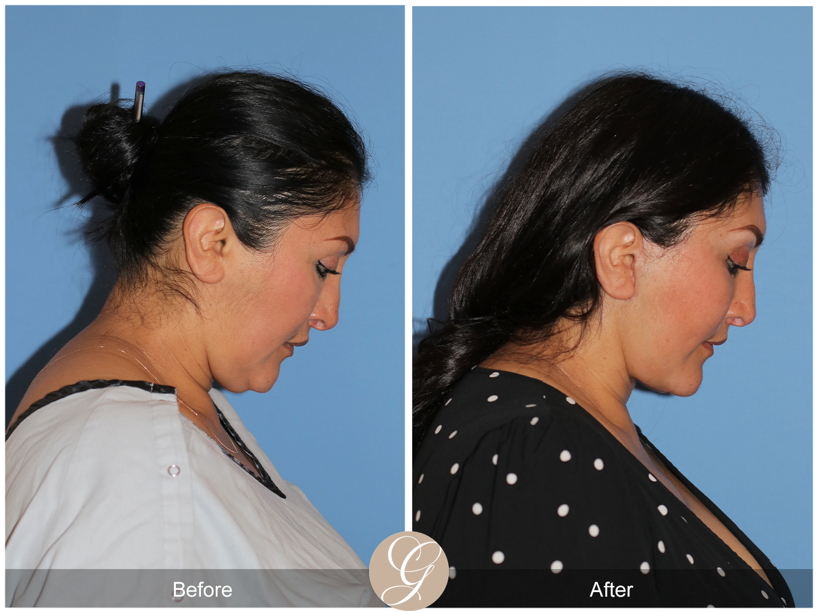 Deep Plane Facelift Case 42 Image