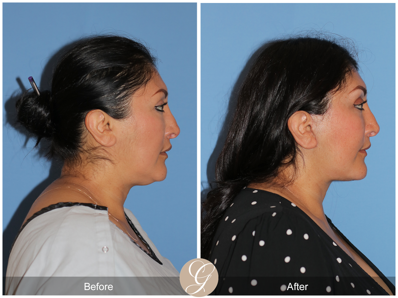 Deep Plane Facelift Case 42 Image