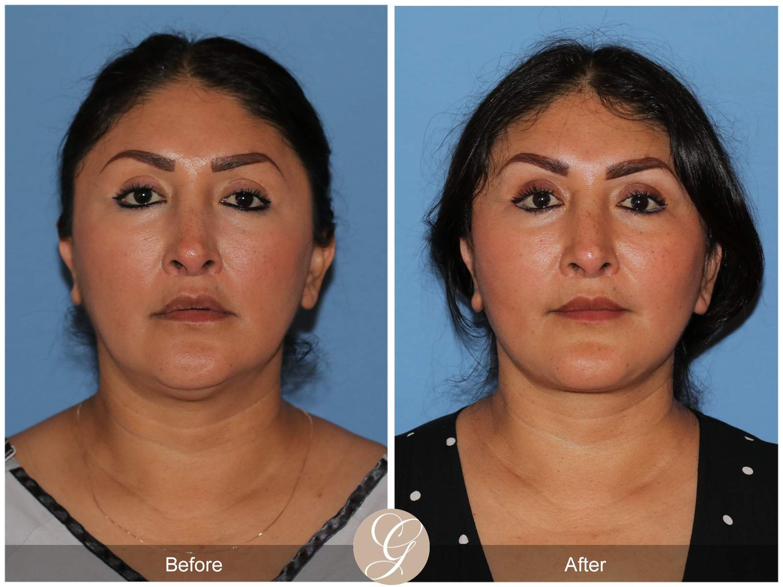 Deep Plane Facelift Case 42 Image