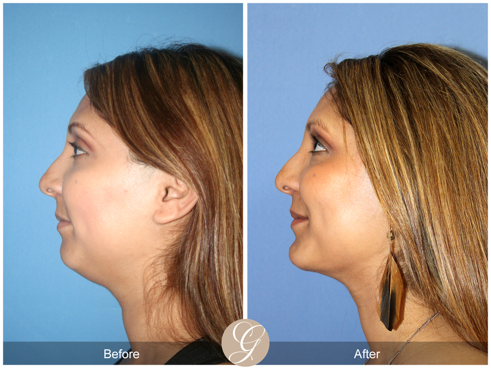 Facial Contouring Case 4 Image