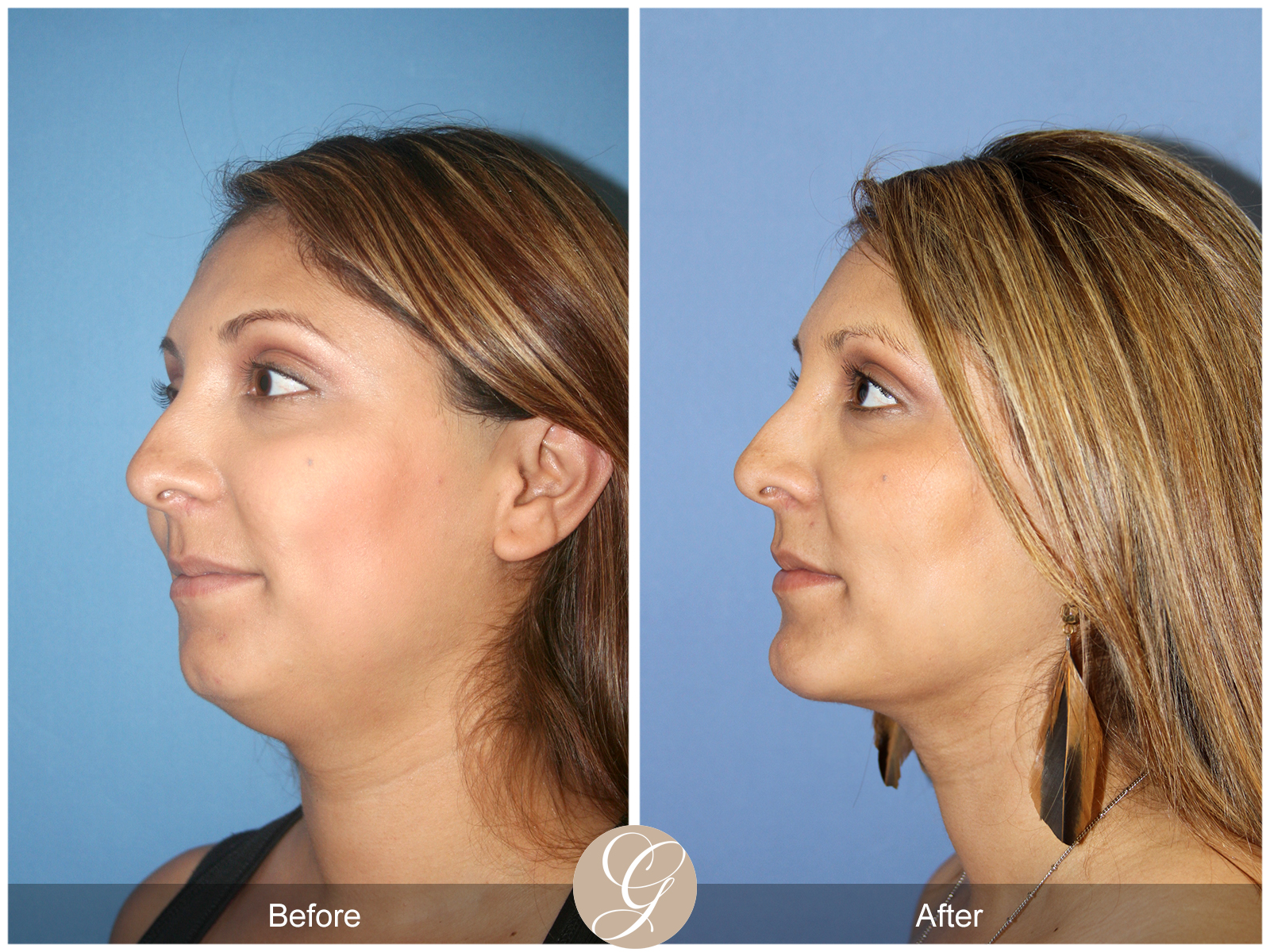 Facial Contouring Case 4 Image