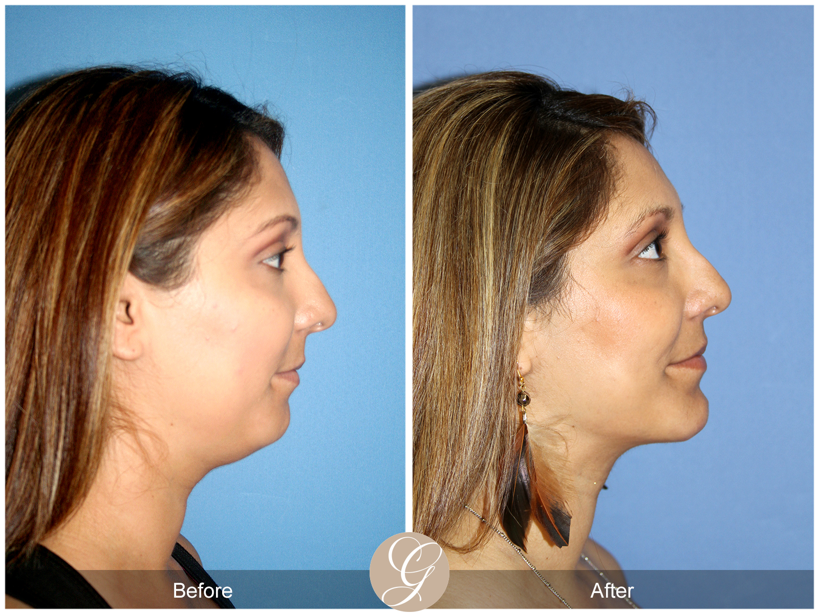 Facial Contouring Case 4 Image