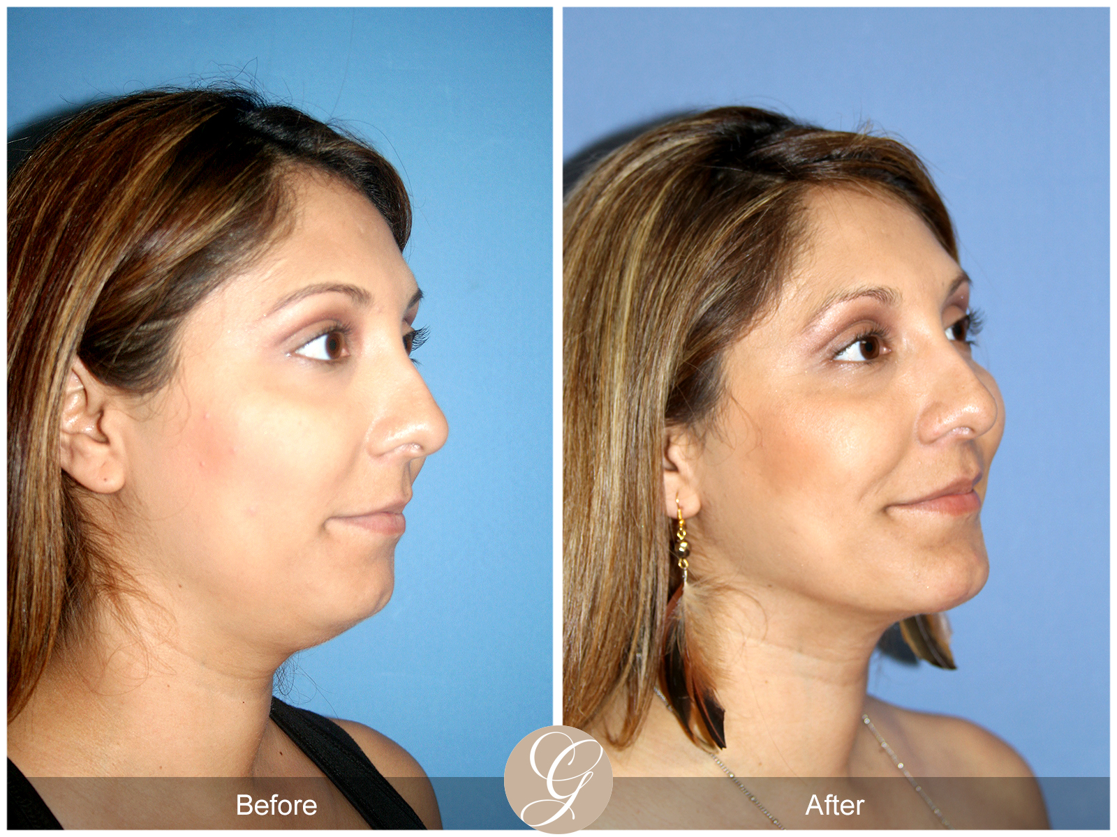 Facial Contouring Case 4 Image