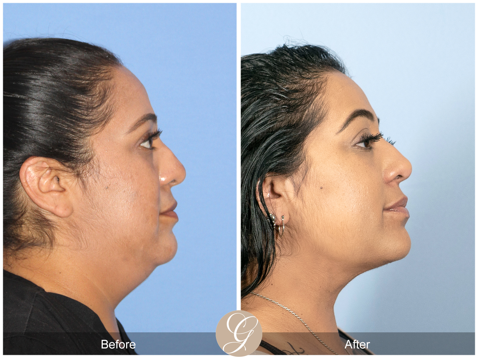 Facial Contouring Case 10 Image
