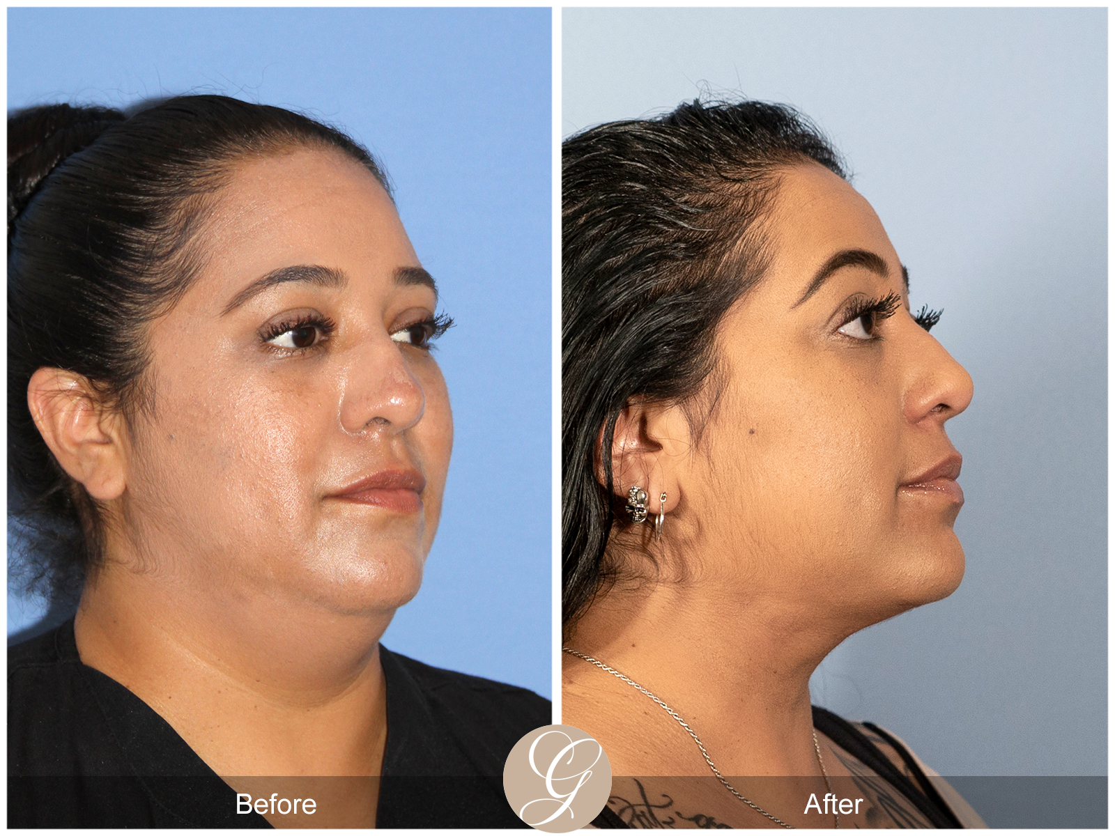 Facial Contouring Case 10 Image