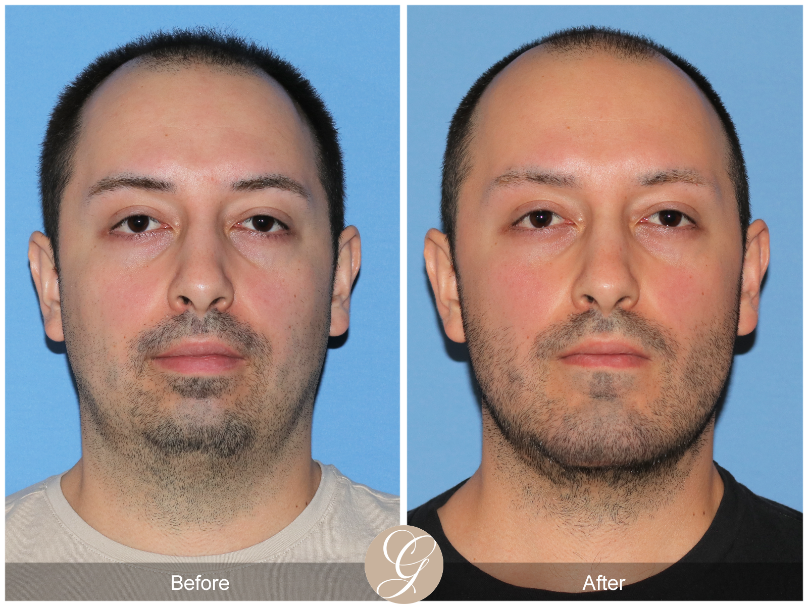 Facial Contouring Case 2 Image