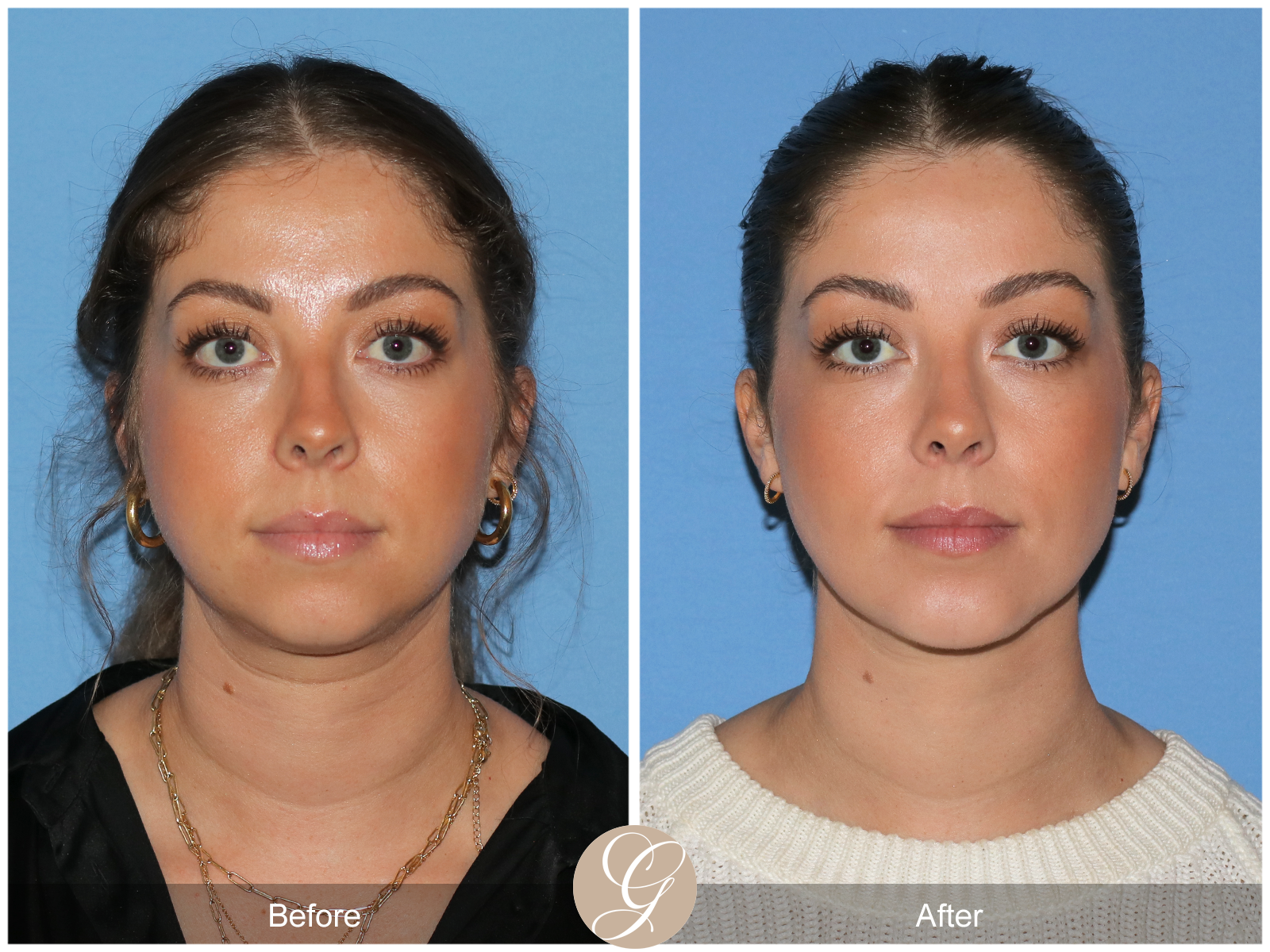 Facial Contouring Case 3 Image