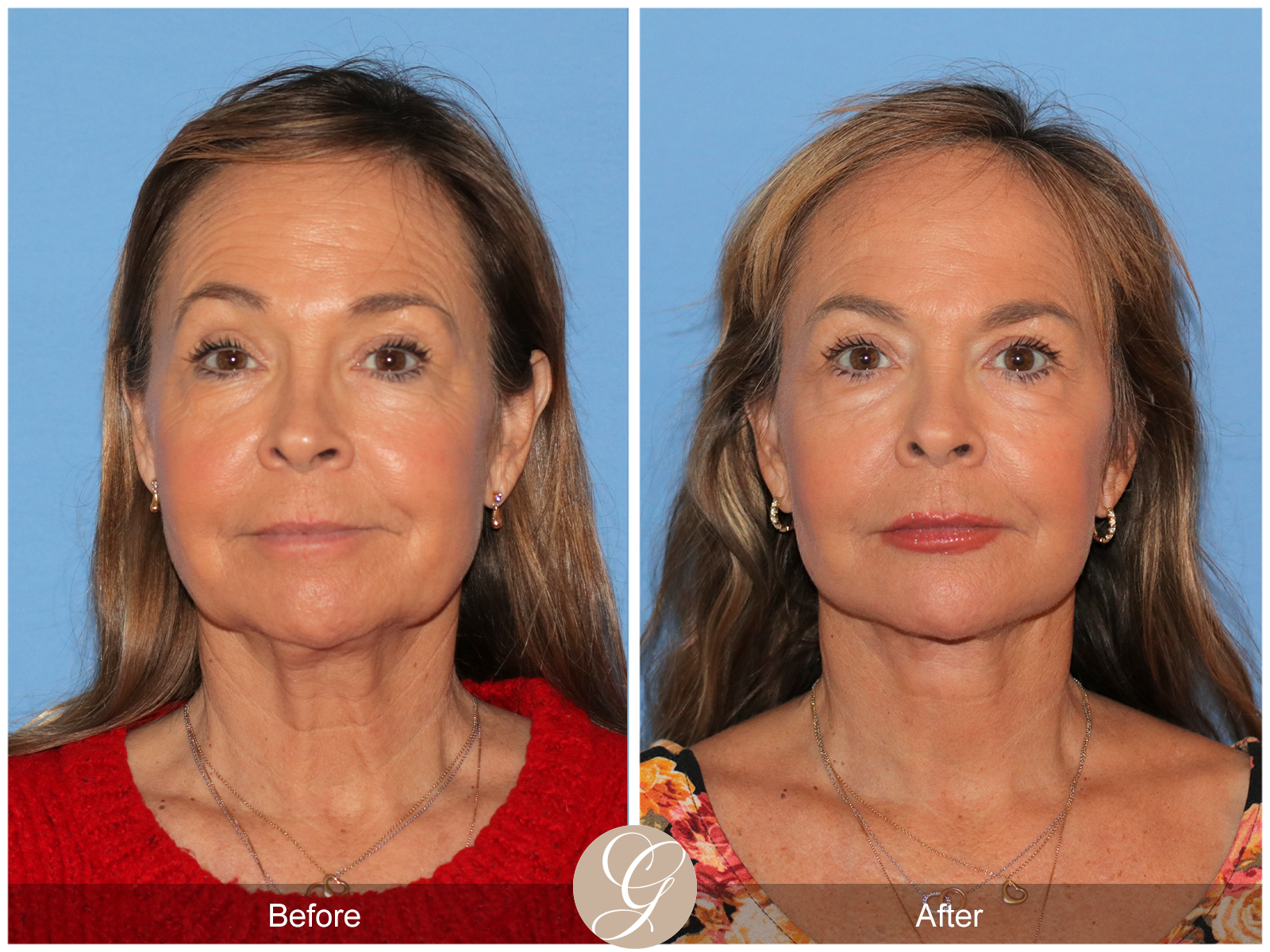 Preservation Deep Plane Facelift Case 45 Image