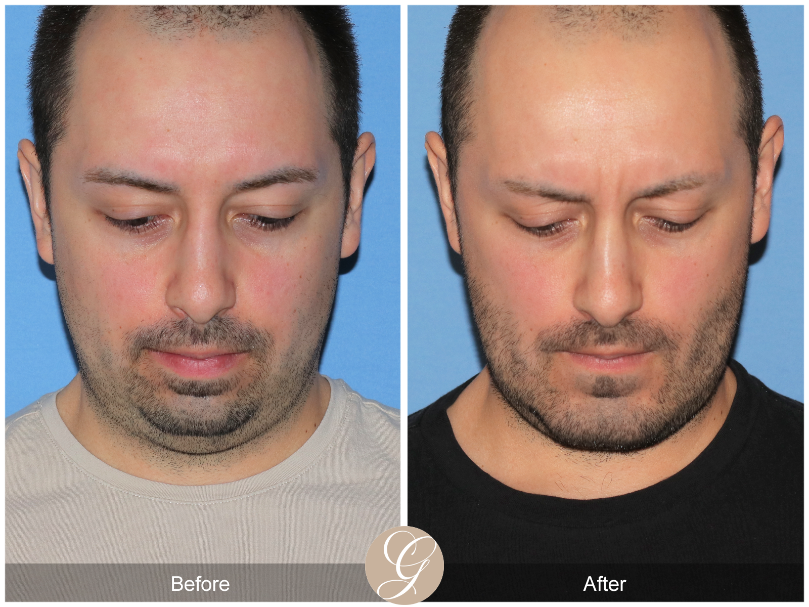 Facial Contouring Case 2 Image