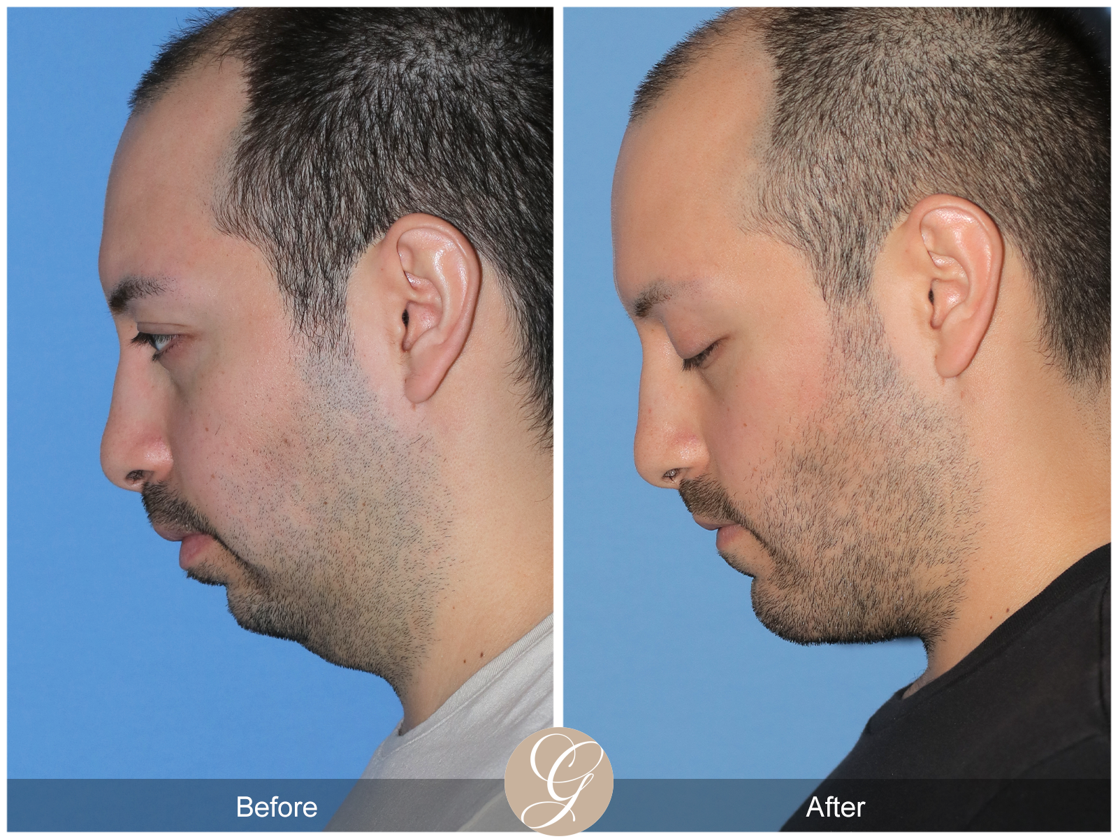 Facial Contouring Case 2 Image