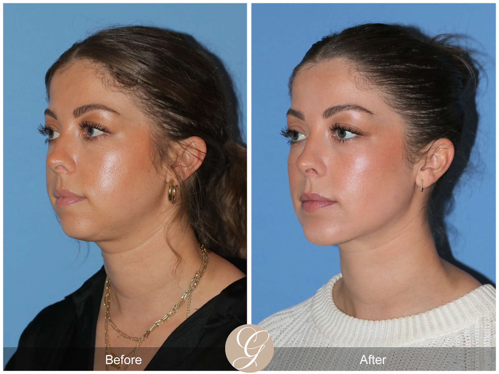 Facial Contouring Case 3 Image