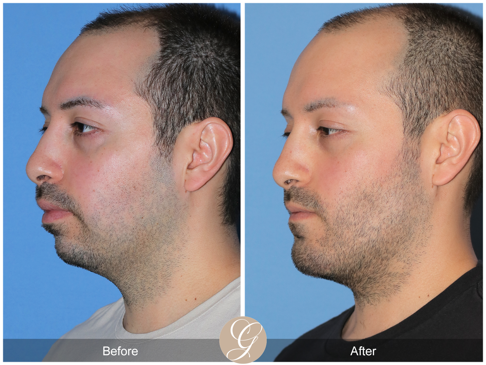 Facial Contouring Case 2 Image
