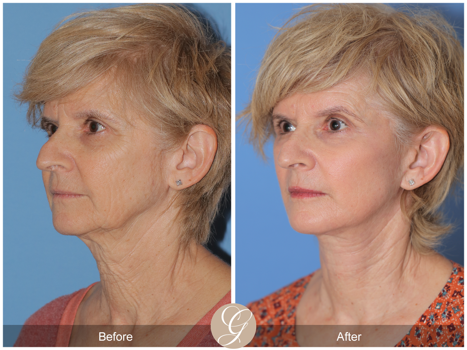 Preservation Deep Plane Facelift Case 39 Image