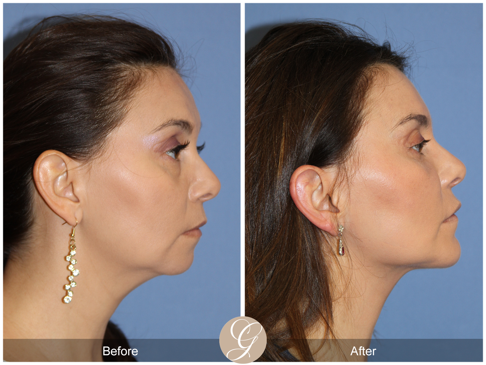 Facial Contouring Case 6 Image