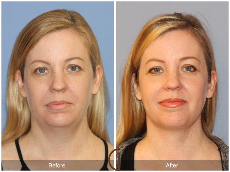 Facial Contouring Case 11 Image