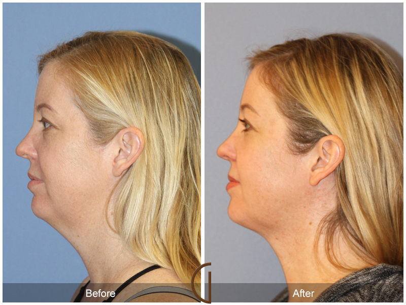 Facial Contouring Case 11 Image