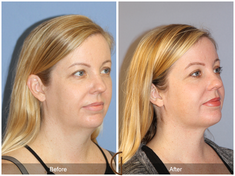 Facial Contouring Case 11 Image