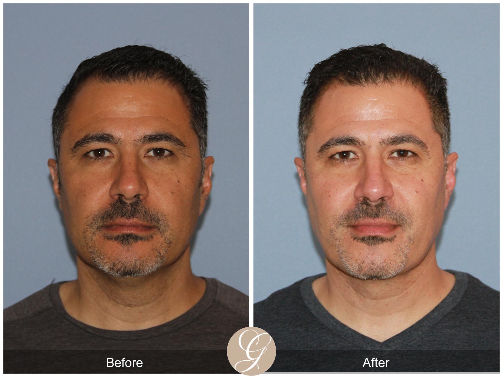 Facial Contouring Case 1 Image