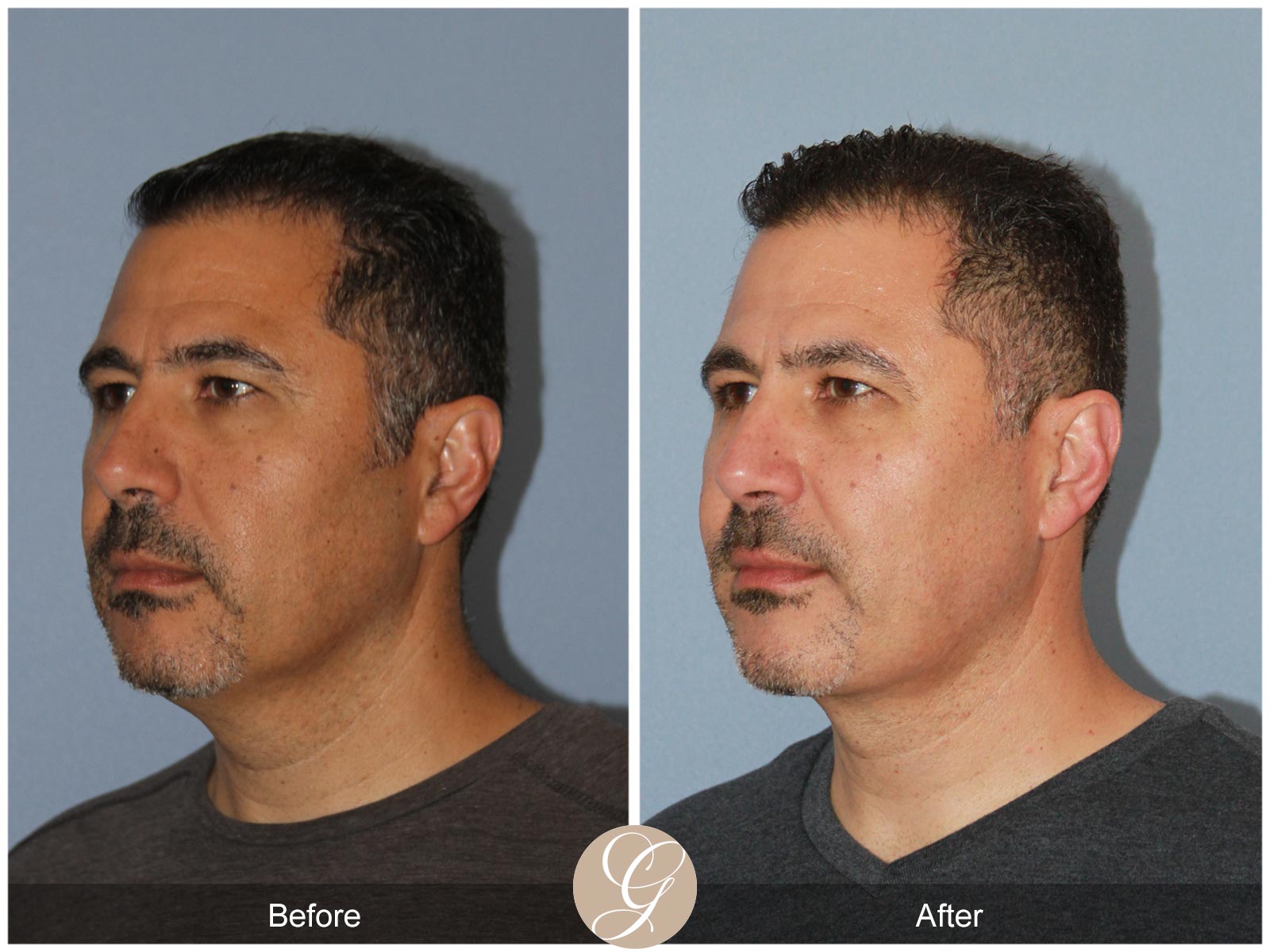 Facial Contouring Case 1 Image