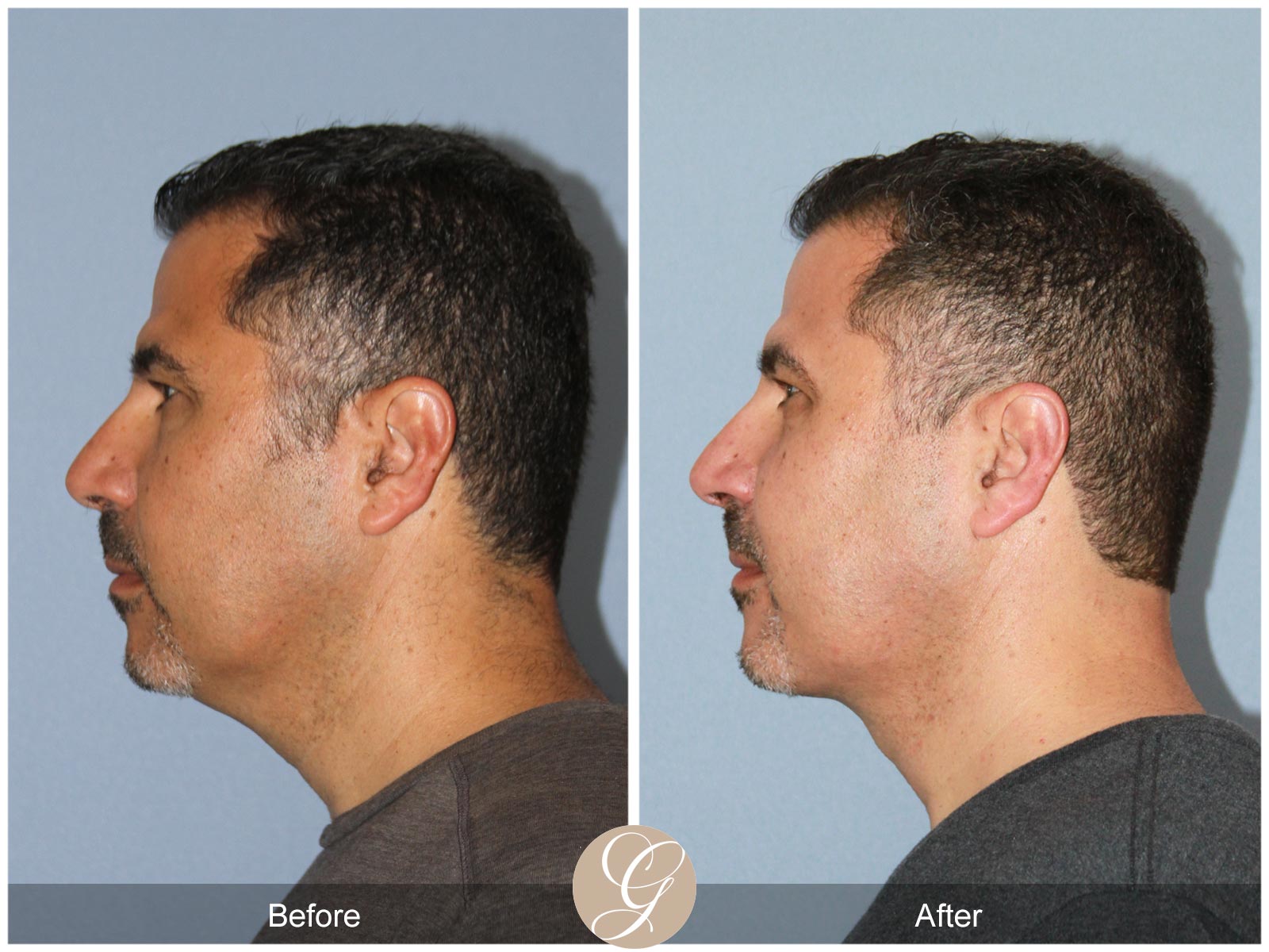 Facial Contouring Case 1 Image