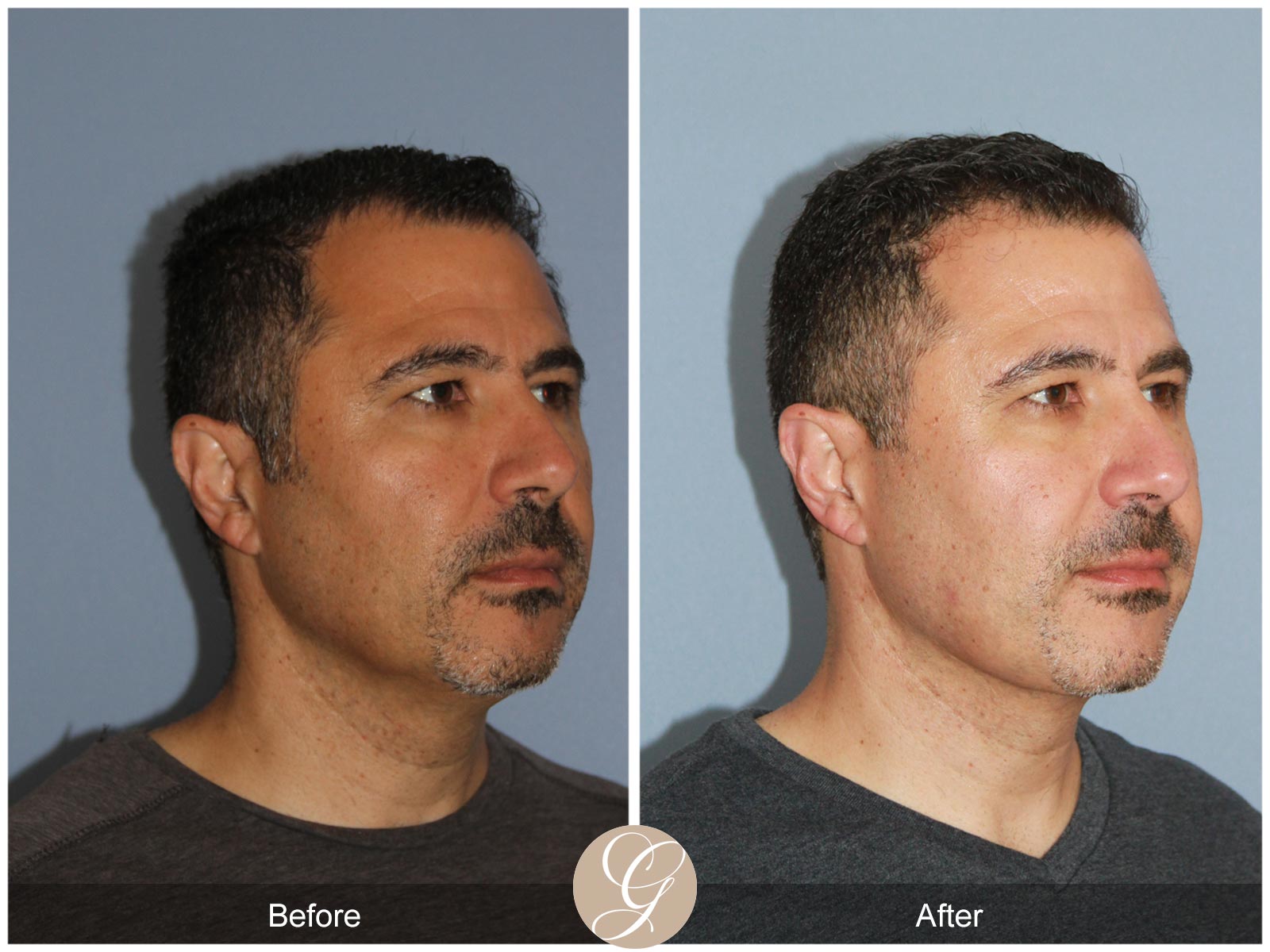 Facial Contouring Case 1 Image