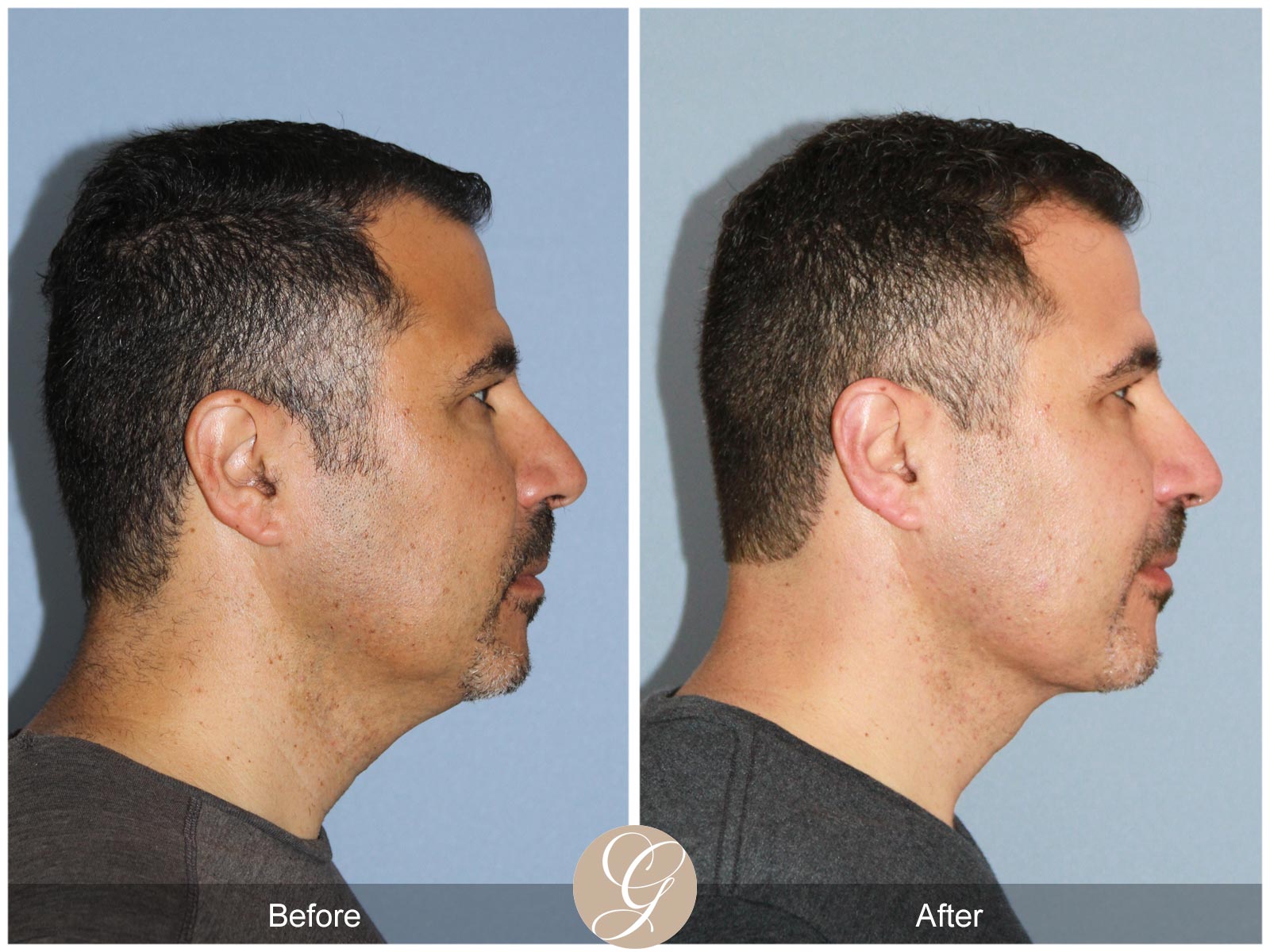 Facial Contouring Case 1 Image