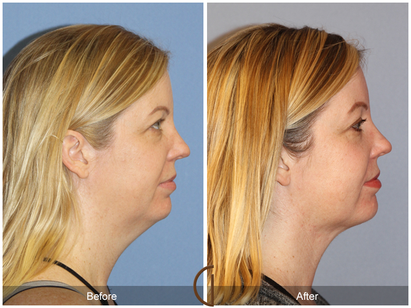 Facial Contouring Case 11 Image