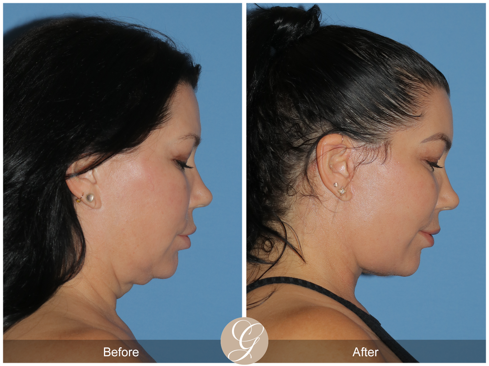 Deep Plane Facelift Case 34 Image
