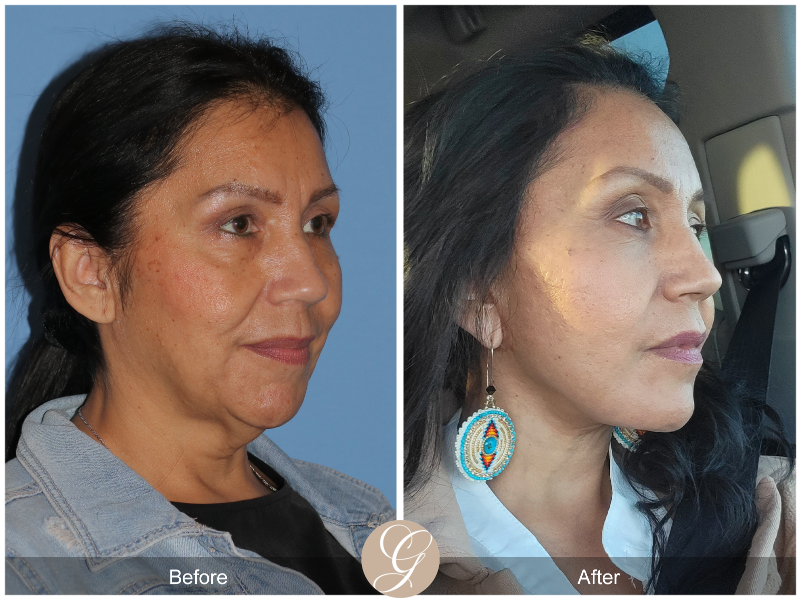 Preservation Deep Plane Facelift Case 38 Image