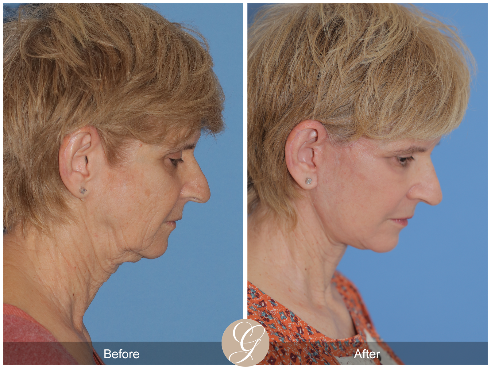 Preservation Deep Plane Facelift Case 39 Image